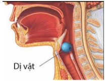 Sơ cấp cứu dị vật đường thở - nghẹt thở