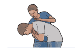 Sơ cấp cứu dị vật đường thở - nghẹt thở