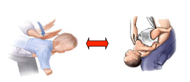 Sơ cấp cứu dị vật đường thở - nghẹt thở