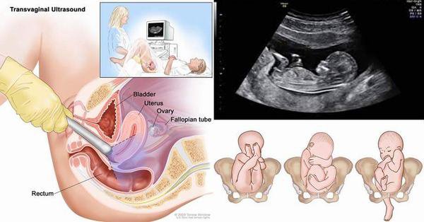 Siêu âm thai 6 tuần tuổi mẹ biết được gì về thai nhi?