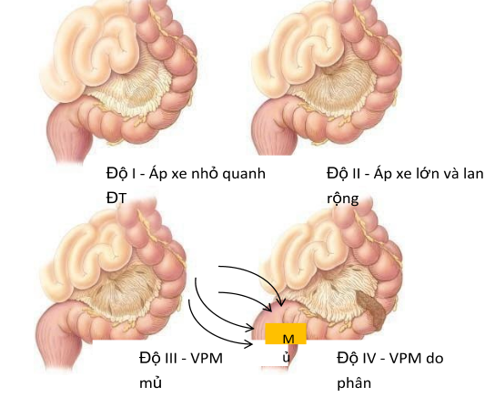 Phân độ bệnh viêm túi thừa đại tràng