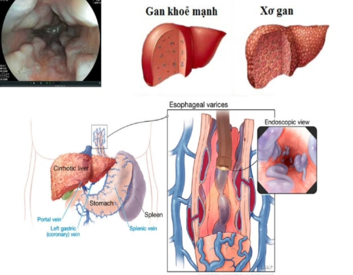 Kỹ thuật tạo Shunt cửa - chủ trong gan qua tĩnh mạch cảnh điều trị bệnh gì?