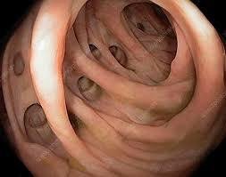 Vai trò của nội soi tiêu hóa trong chẩn đoán và điều trị viêm túi thừa đại tràng