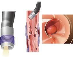 Vai trò của nội soi tiêu hóa trong chẩn đoán và điều trị viêm túi thừa đại tràng