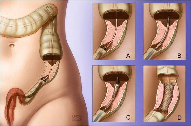Vai trò của nội soi tiêu hóa trong chẩn đoán và điều trị viêm túi thừa đại tràng