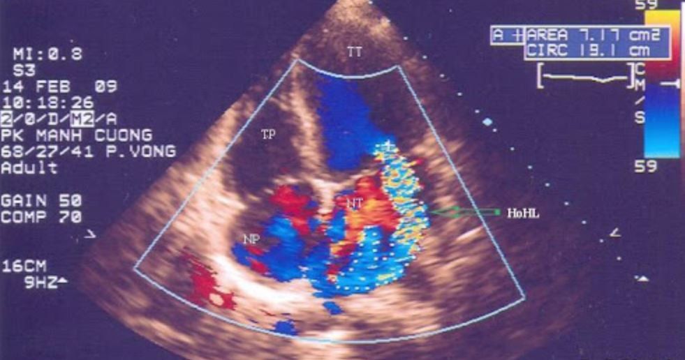 Siêu âm tim Doppler màu đánh giá hở van hai lá