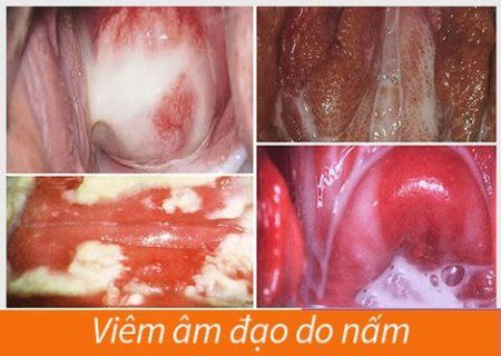 Trắc nghiệm: Bạn biết gì về nhiễm trùng nấm men âm đạo?