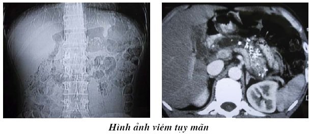 Chụp cắt lớp vi tính viêm tụy mãn