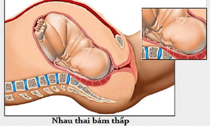 Vị trí bánh nhau thai có gì đặc biệt?