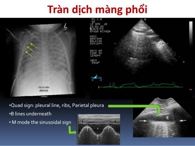 Siêu âm màng phổi: Những điều cần biết