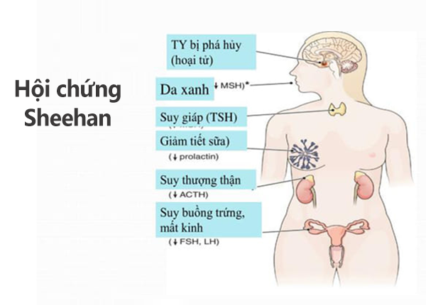 Nguyên nhân gây suy giảm hormone tuyến yên