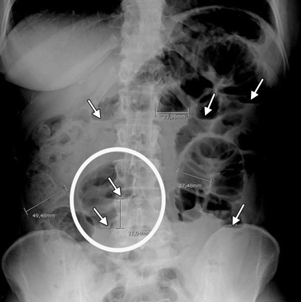 Hình ảnh X quang trong chẩn đoán tắc ruột