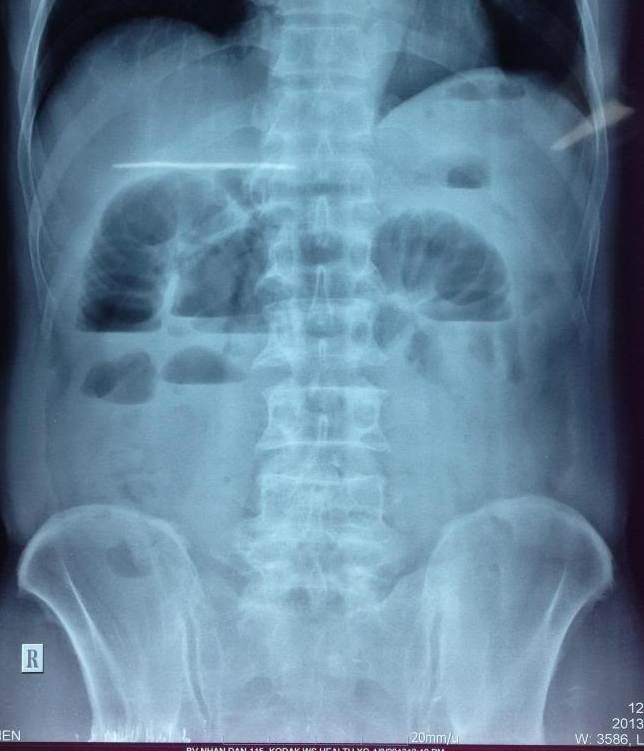 Hình ảnh X quang trong chẩn đoán tắc ruột