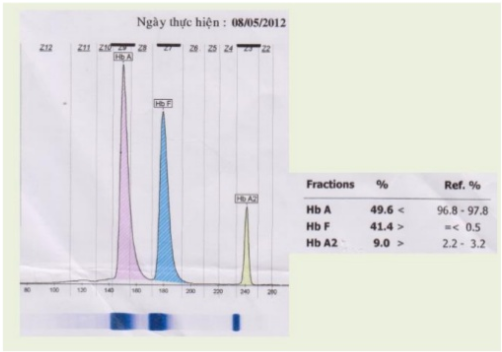 XÉT NGHIỆM ĐIỆN DI HUYẾT SẮC TỐHEMOGLOBIN