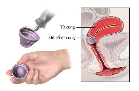 Mũ chụp cổ tử cung có an toàn không?
