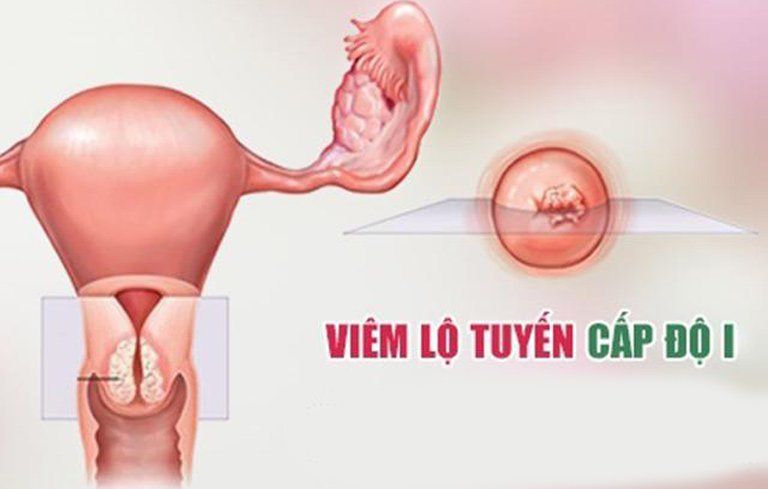 Viêm lộ tuyến cổ tử cung 1cm là nặng hay nhẹ ?