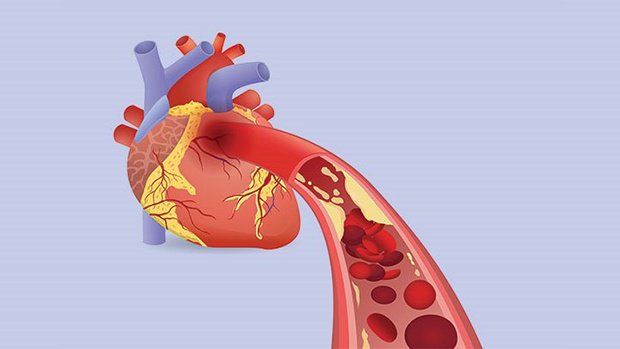 Sự nguy hiểm của thiếu máu cơ tim thầm lặng