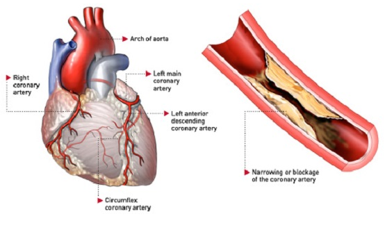 Sự nguy hiểm của thiếu máu cơ tim thầm lặng