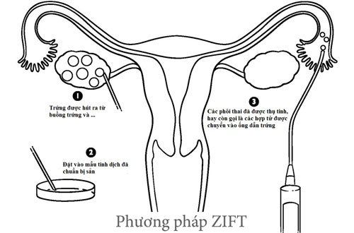 Chuyển hợp tử vào ống dẫn trứng (ZIFT): 7 điều cần biết
