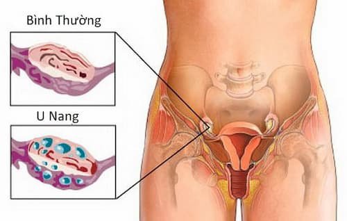 Thuốc điều trị u nang tử cung được dùng khi nào?