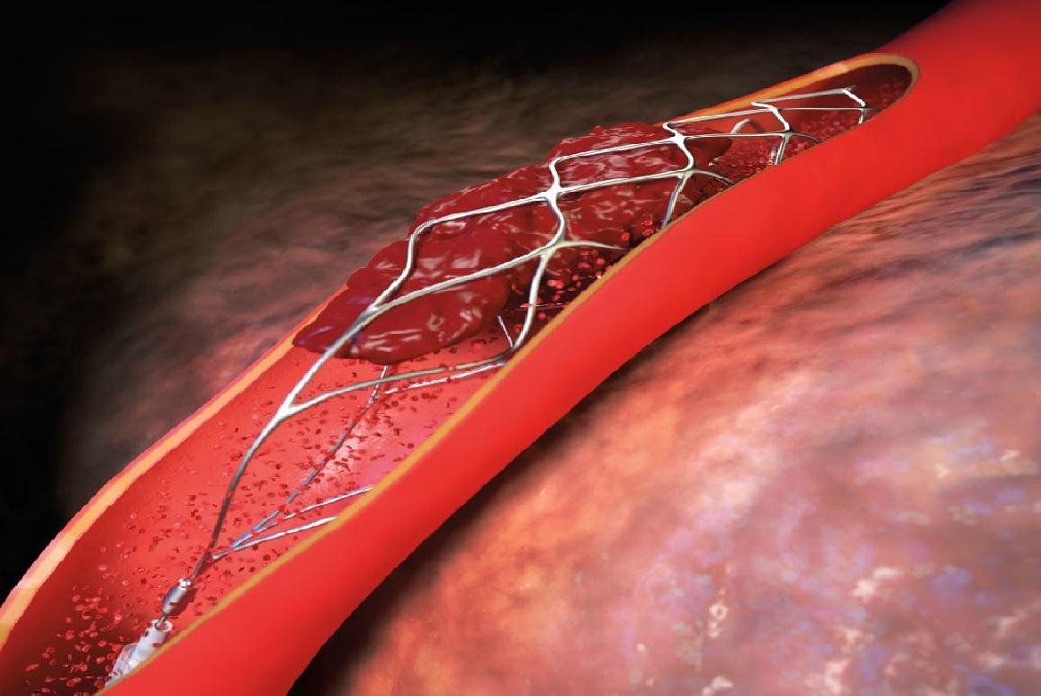Các biến chứng có thể gặp sau đặt stent mạch vành