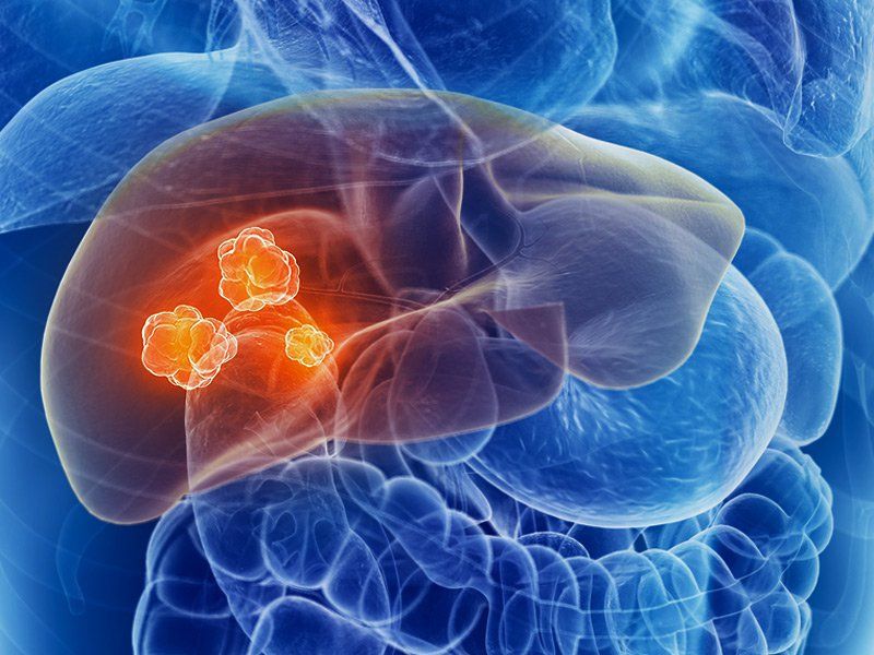 Áp xe gan có thể chẩn đoán khi chụp CT scan bụng chậu không