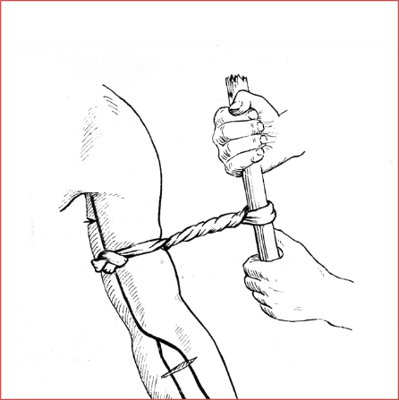 Cách sơ cứu khi bị vết thương gây chảy máu bên ngoài