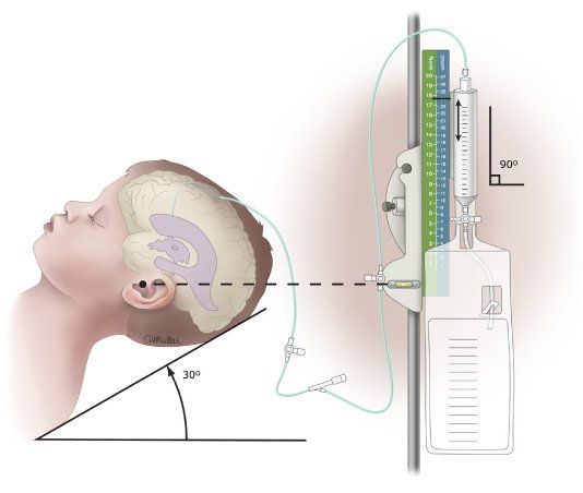 Như thế nào là dẫn lưu não thất ổ bụng?