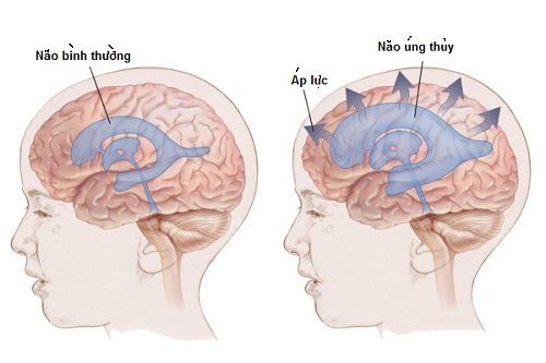 Như thế nào là dẫn lưu não thất ổ bụng?