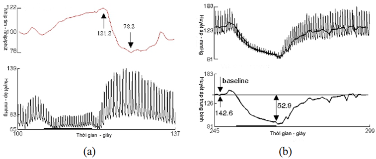 Test đáp ứng nhịp tim với nghiệm pháp Valsalva