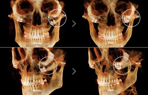 Phương pháp nào thường được sử dụng để chụp X-quang gãy xương gò má? 

