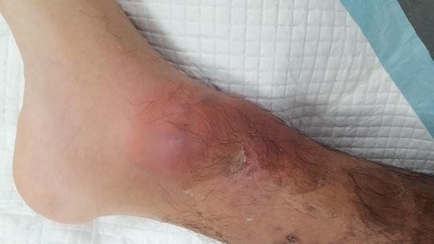 Các đặc điểm hình ảnh học của viêm mô tế bào