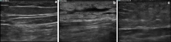 Các đặc điểm hình ảnh học của viêm mô tế bào