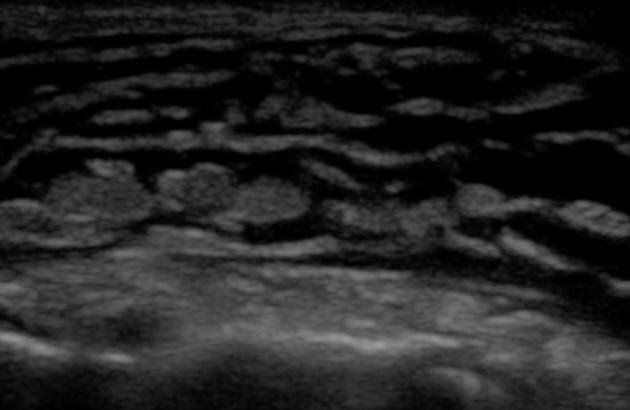 Các đặc điểm hình ảnh học của viêm mô tế bào