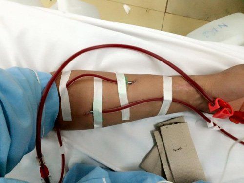 Yếu tố ảnh hưởng tới quả lọc trong điều trị thay thế thận liên tục