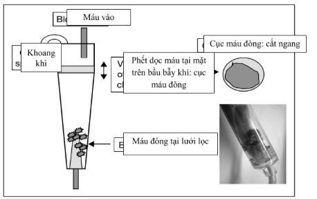 Suy yếu thận nhân tạo và chiến lược tối ưu đời sống quả lọc trong điều trị thay thế thận liên tục