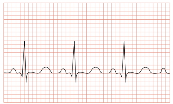 Nhịp tim của trẻ sơ sinh được coi là bình thường khi nằm trong khoảng tần số nào?
