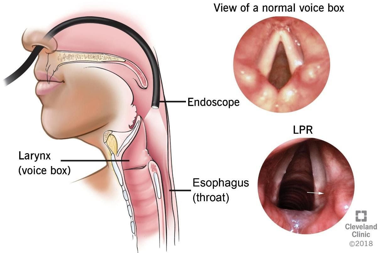 Các phương pháp điều trị bằng thuốc trong bệnh trào ngược thanh quản Phần 1