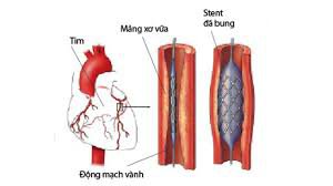 Đặt stent động mạch vành loại phủ thuốc có an toàn hơn các loại stent khác?