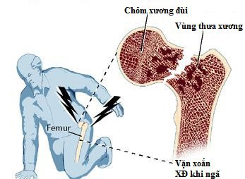 Những kỹ thuật y tế nào giúp chẩn đoán gãy xương hông?