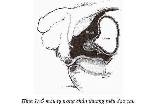 Kỹ thuật thực hiện dẫn lưu bàng quang trên xương mu