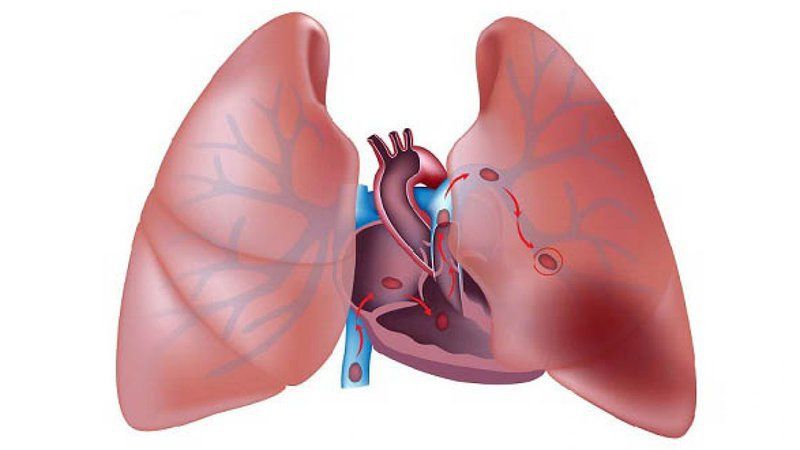Các tiêu chí chẩn đoán thuyên tắc động mạch phổi cấp tính