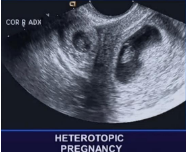 Một số cập nhật về siêu âm chẩn đoán chửa ngoài tử cung