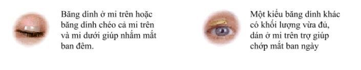 Liệt dây thần kinh VII ngoại biên do lạnh (liệt mặt Bell)