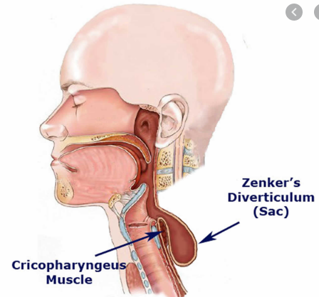 Điều trị Túi thừa Zenker ở thực quản qua nội soi