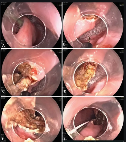 Điều trị Túi thừa Zenker ở thực quản qua nội soi