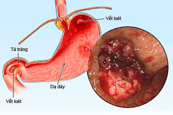 Thuốc Lansoprazole: Công dụng, chỉ định và lưu ý khi dùng