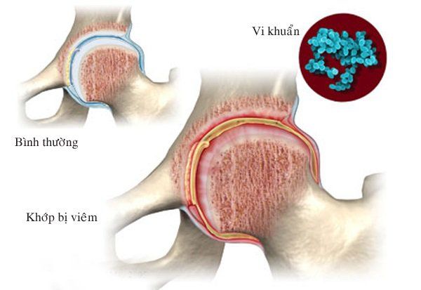 Có thể sử dụng kháng sinh điều trị viêm khớp nhiễm khuẩn không?
