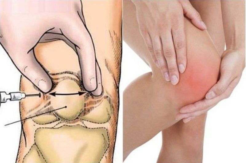 Có thể sử dụng kháng sinh điều trị viêm khớp nhiễm khuẩn không?