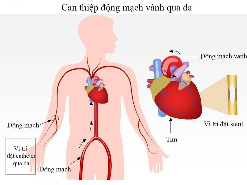 Các loại stent động mạch vành phổ biến được dùng tại Việt Nam